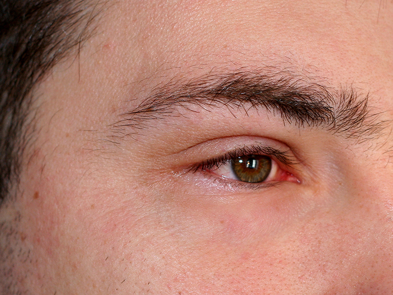 Mann mit Augenentzündung